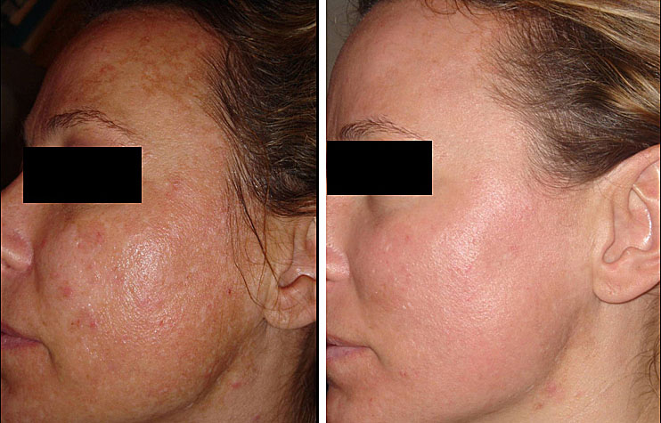 Brown Spots on Skin & Discoloration | Paula's Choice