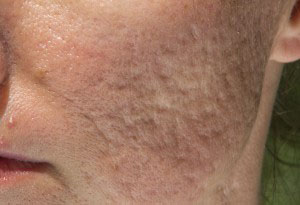 Close Up of Acne Scarring