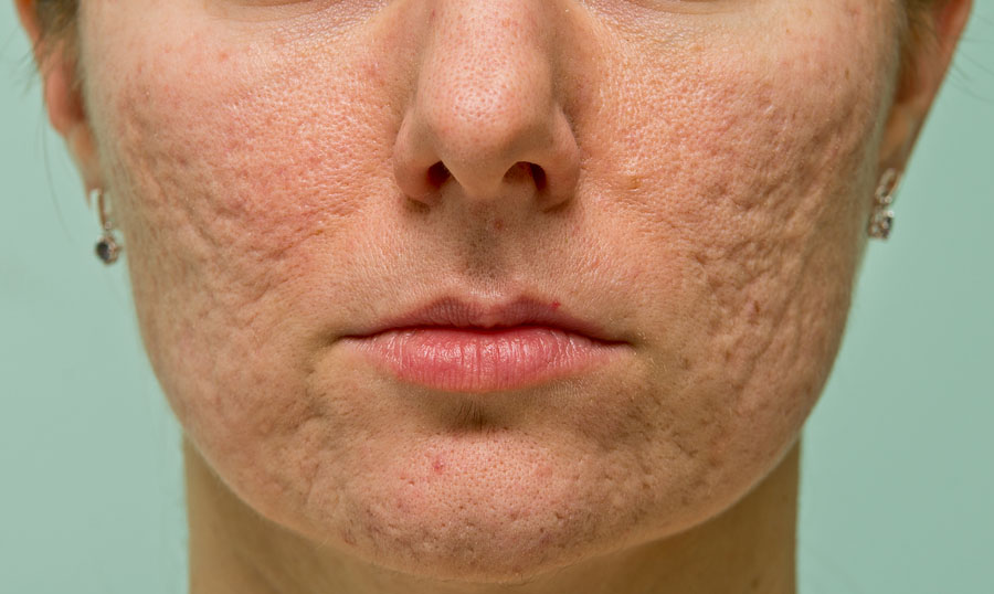 Severe-Acne-Scarring.jpg