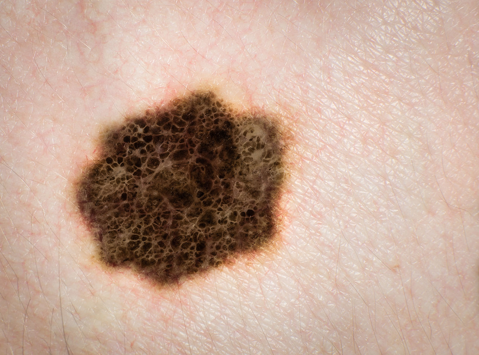 Melanoma - SkinCancer.org - Skin Cancer Foundation