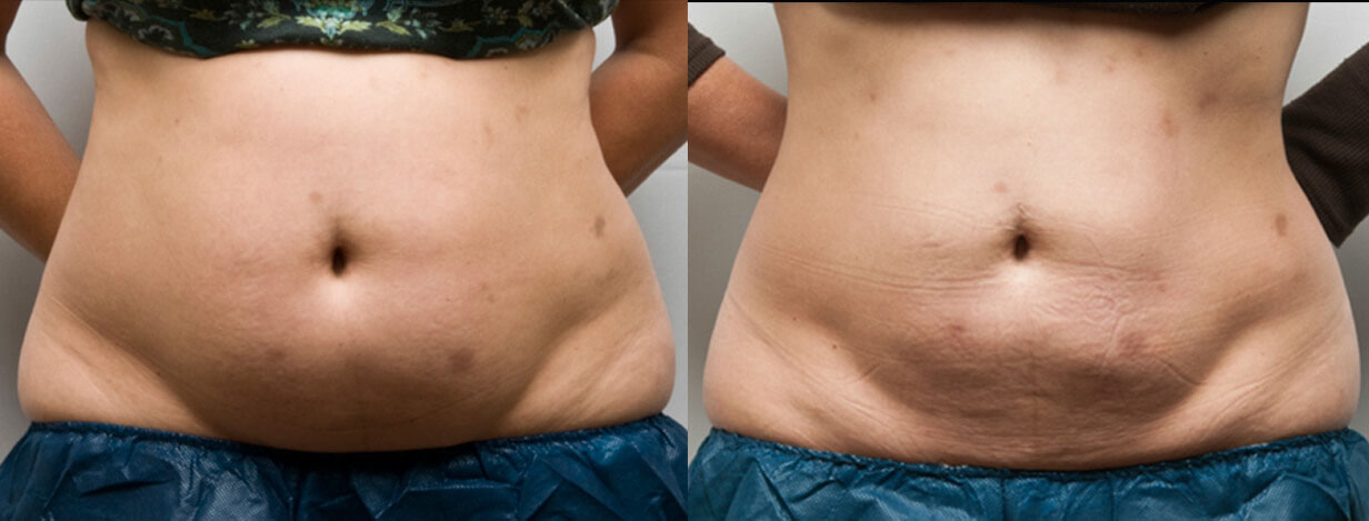 Love Handles CoolSculpting: Procedure, Results, Side Effects