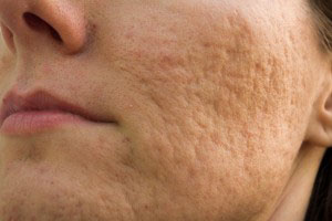 Acne scars