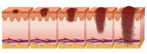 Stages of Melanoma Illustration