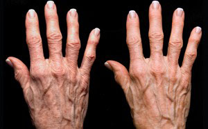 Anti-Aging Treatments for Hands at Mayoral Dermatology