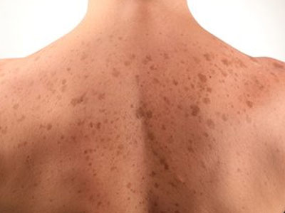 Brown Spots - Mayoral Dermatology