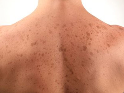 Age Spots (Solar Lentigo, Liver Spots) - Harvard Health