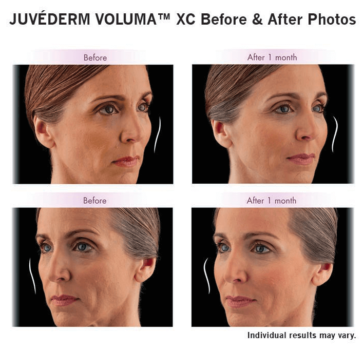 JUVÉDERM VOLUMA™ XC before and after 1