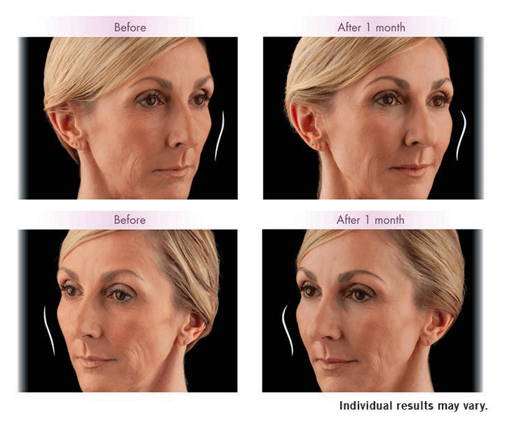 JUVÉDERM VOLUMA™ XC before and after 2