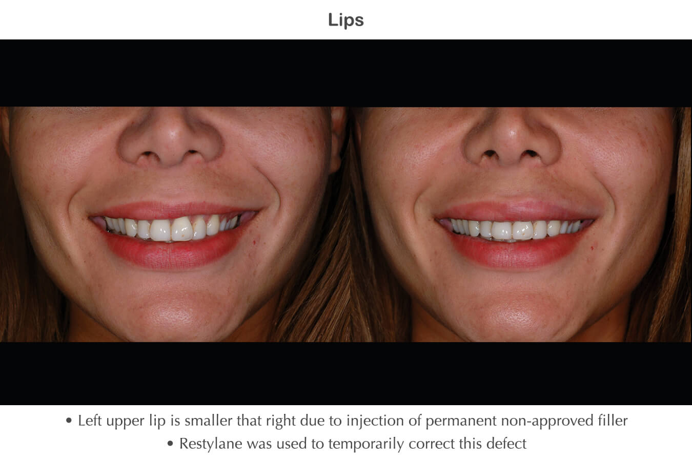 dermatology fillers dermatology fillers